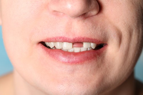 Tooth loss linked to life expectancy